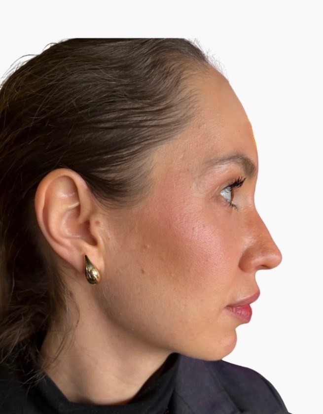 Jawline & Profile — after Ultherapy