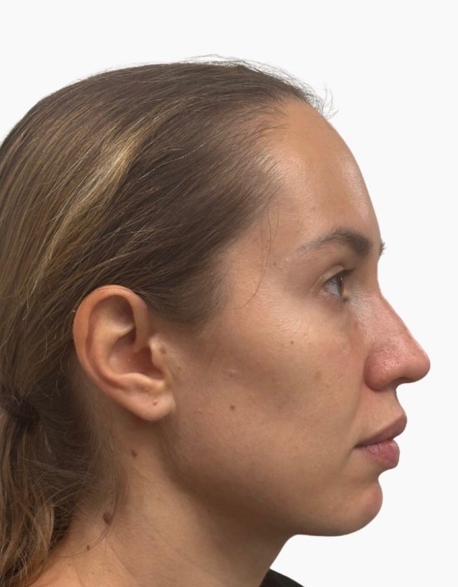 Jawline & Profile — before Ultherapy
