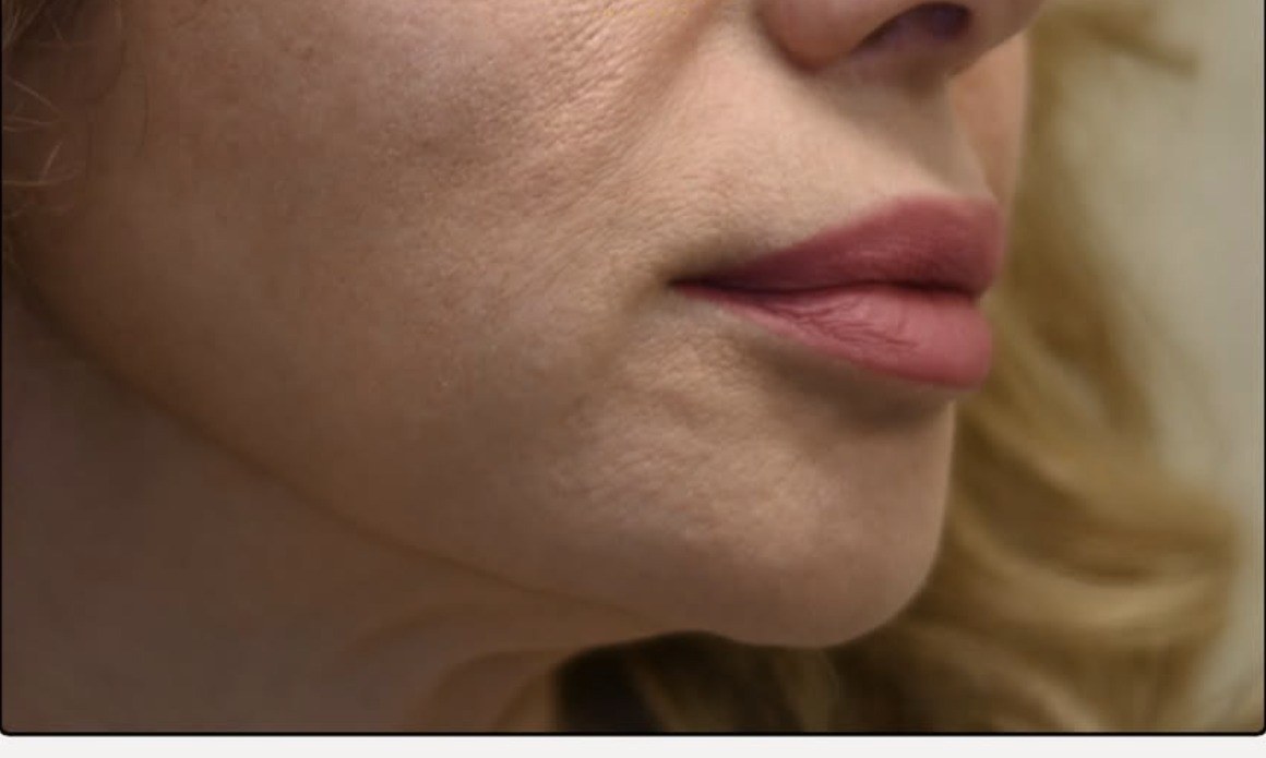 Lower Face & Mouth Corners — after Ultherapy