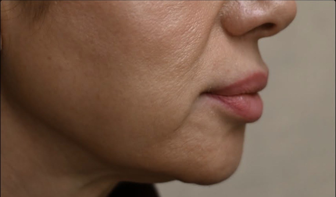 Lower Face & Mouth Corners — before Ultherapy