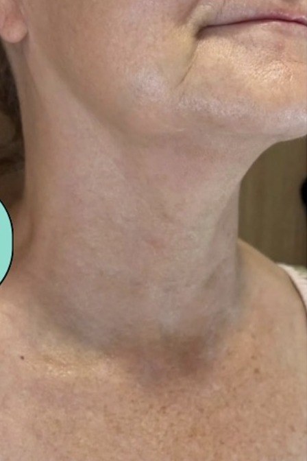 Neck & Décolleté — after Ultherapy