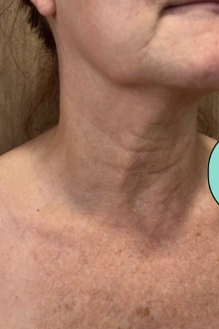 Neck & Décolleté — before Ultherapy
