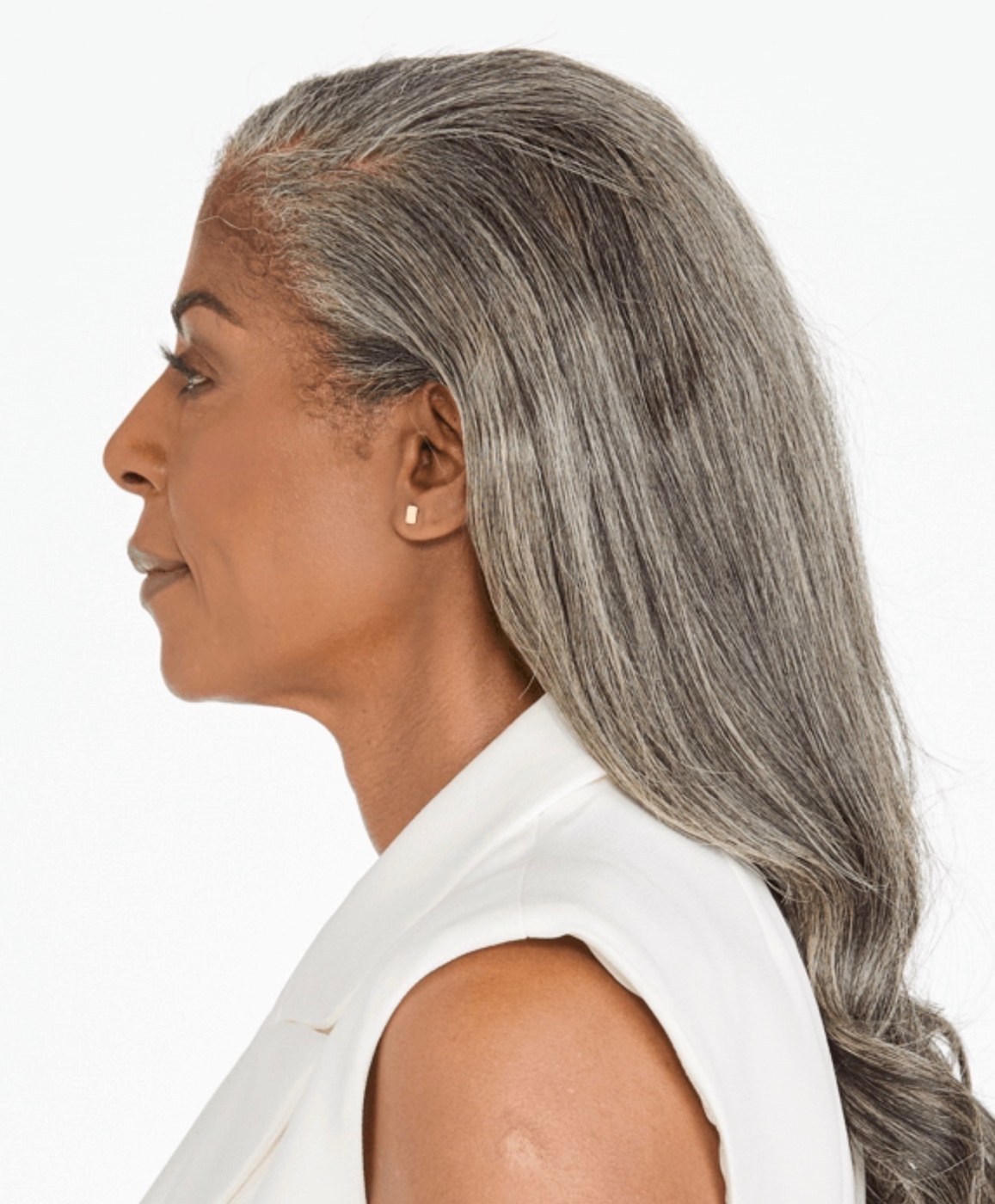Full Face & Jawline — after Ultherapy